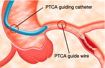 Passing through of PTCA guide wire