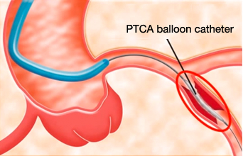 Insertion of PTCA balloon catheter