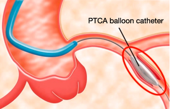 Inflation of PTCA balloon catheter
