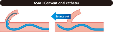 ASAHI Conventional catheter